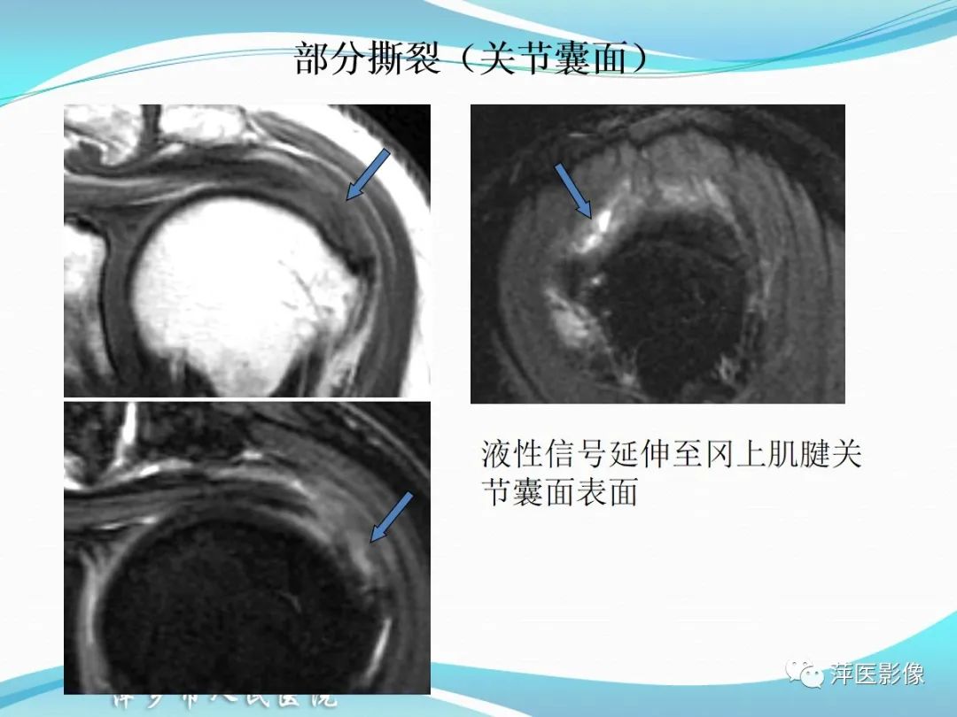 影像PPT - 【PPT】肩关节磁共振读片-35