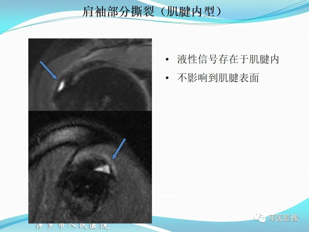 影像PPT - 【PPT】肩关节磁共振读片-36