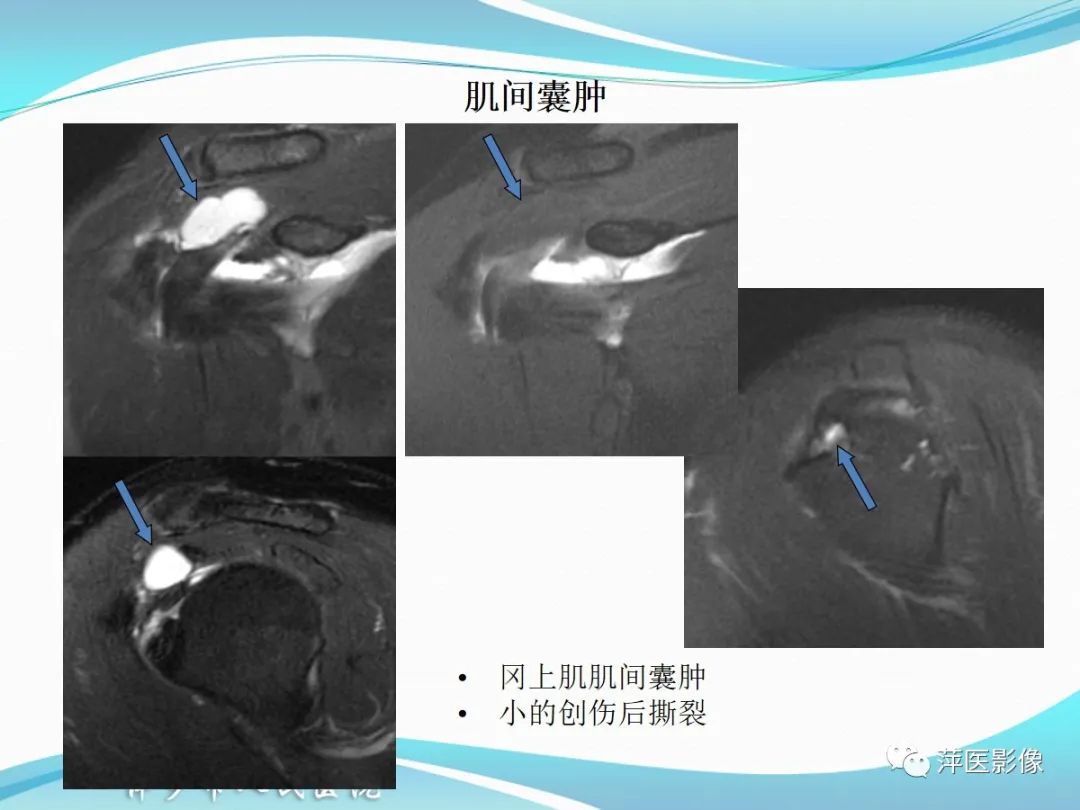 影像PPT - 【PPT】肩关节磁共振读片-38
