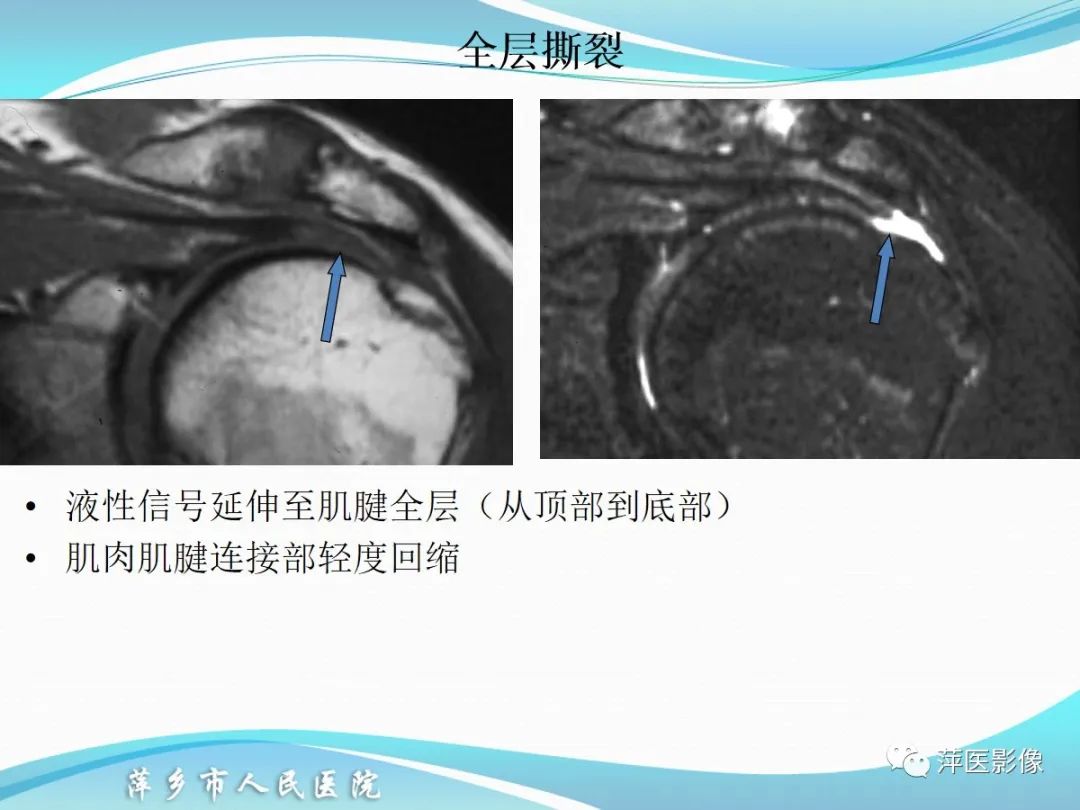 影像PPT - 【PPT】肩关节磁共振读片-39