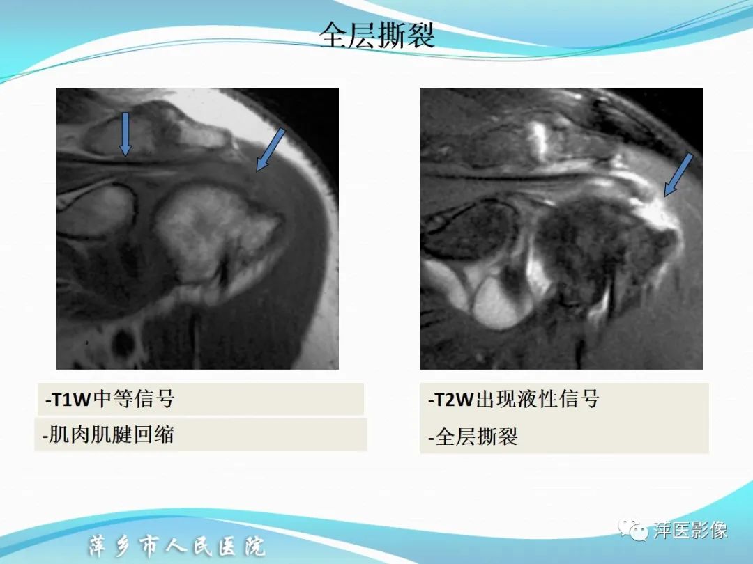 影像PPT - 【PPT】肩关节磁共振读片-41