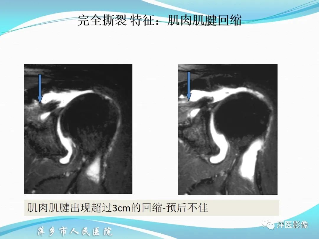 影像PPT - 【PPT】肩关节磁共振读片-42