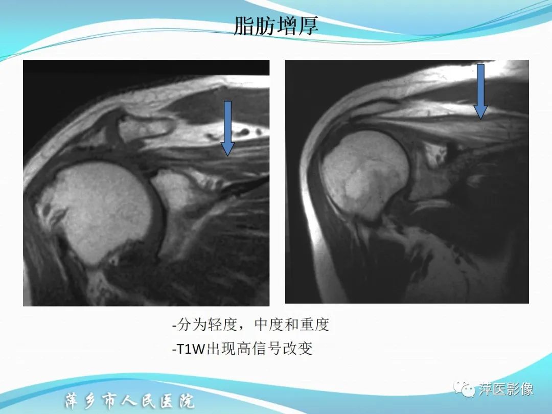 影像PPT - 【PPT】肩关节磁共振读片-43