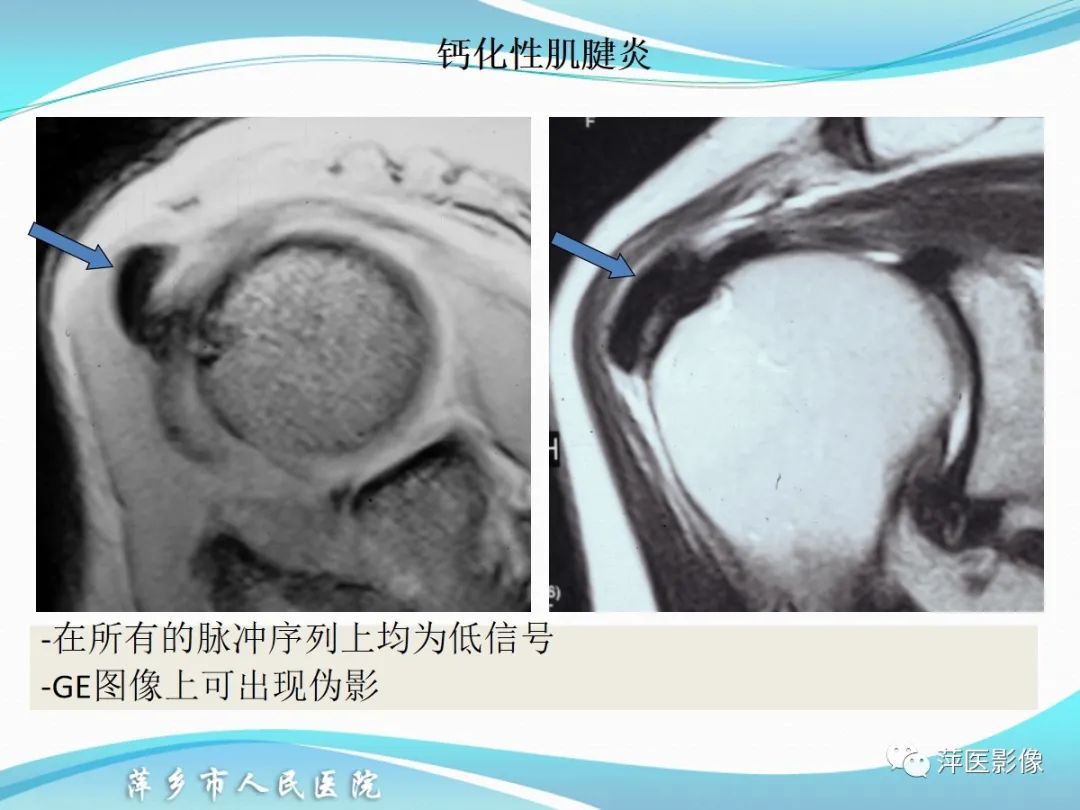 影像PPT - 【PPT】肩关节磁共振读片-44