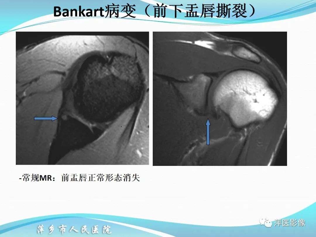 影像PPT - 【PPT】肩关节磁共振读片-48