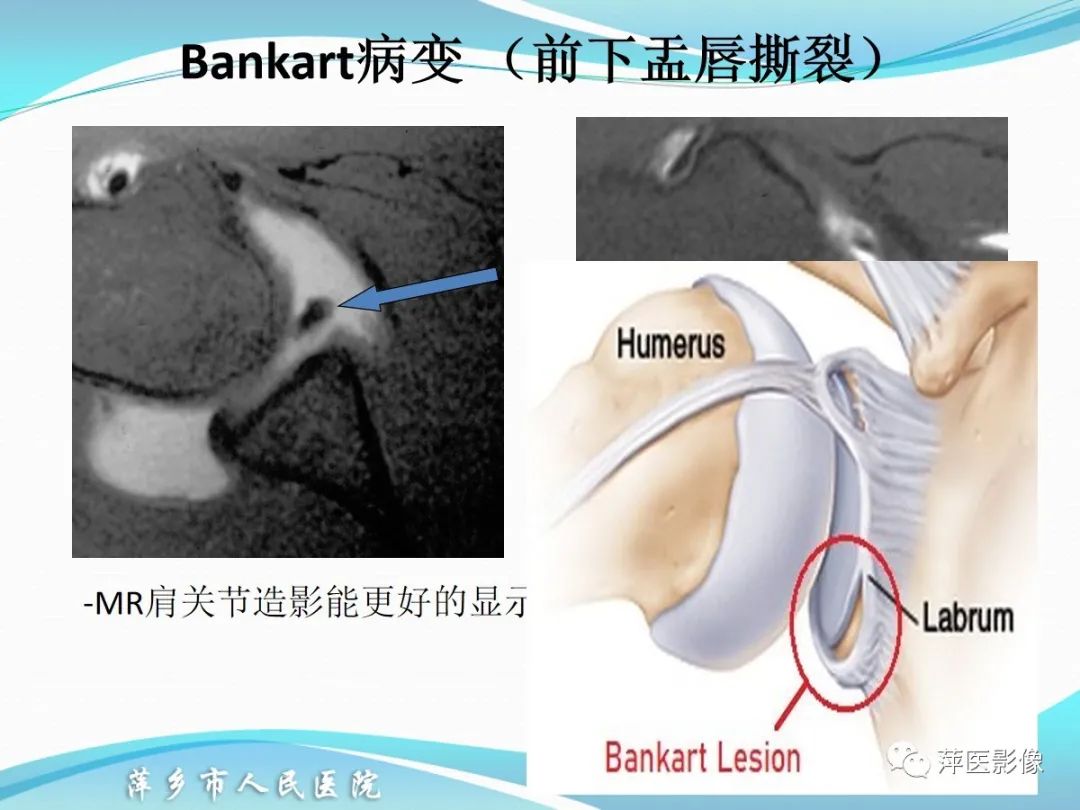 影像PPT - 【PPT】肩关节磁共振读片-49