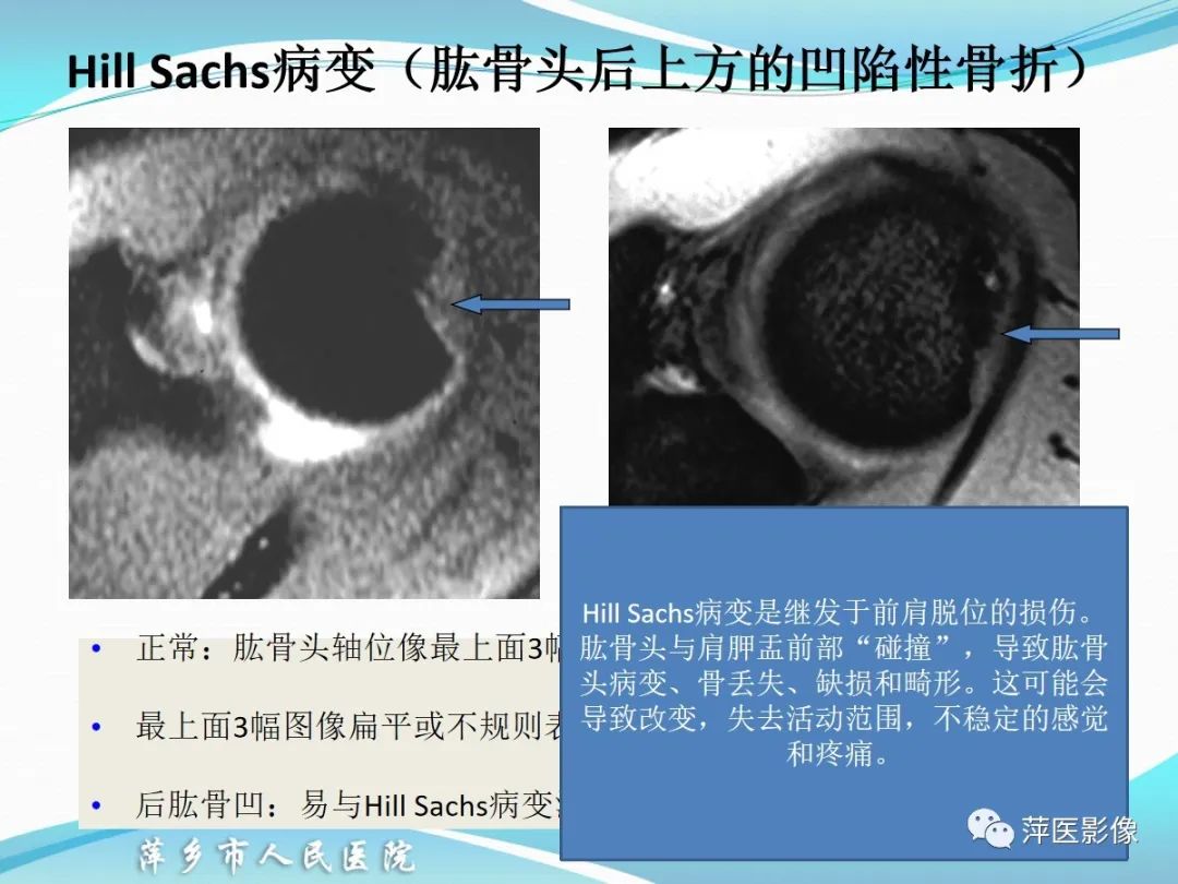 影像PPT - 【PPT】肩关节磁共振读片-50