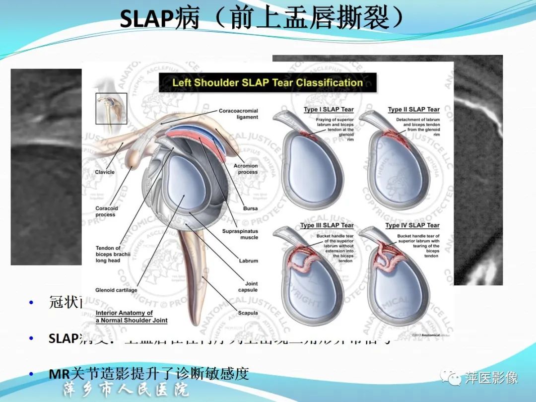 影像PPT - 【PPT】肩关节磁共振读片-51