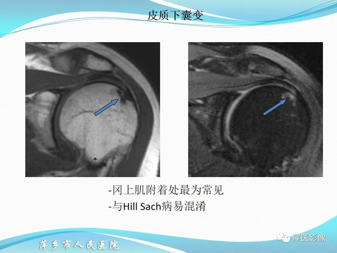 影像PPT - 【PPT】肩关节磁共振读片-54