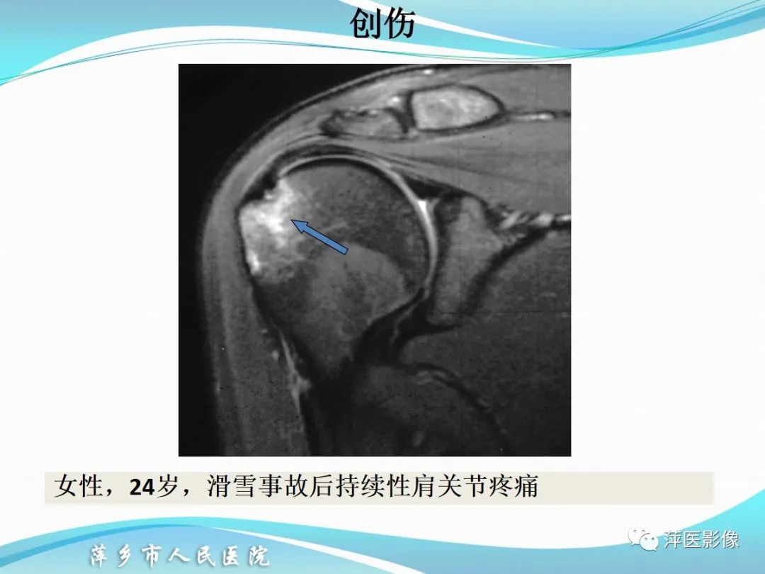 影像PPT - 【PPT】肩关节磁共振读片-55