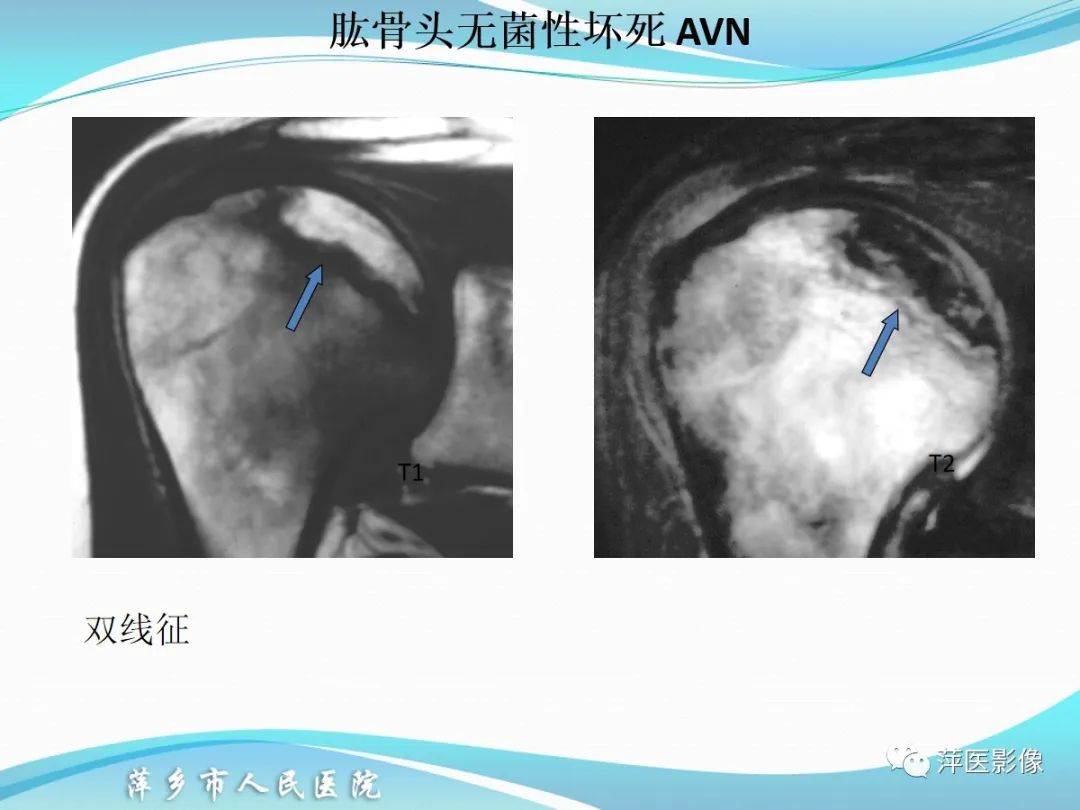影像PPT - 【PPT】肩关节磁共振读片-56