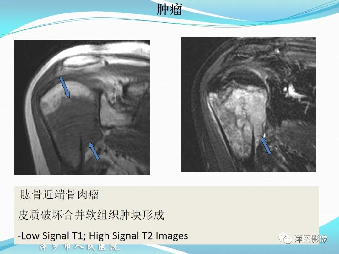 影像PPT - 【PPT】肩关节磁共振读片-57