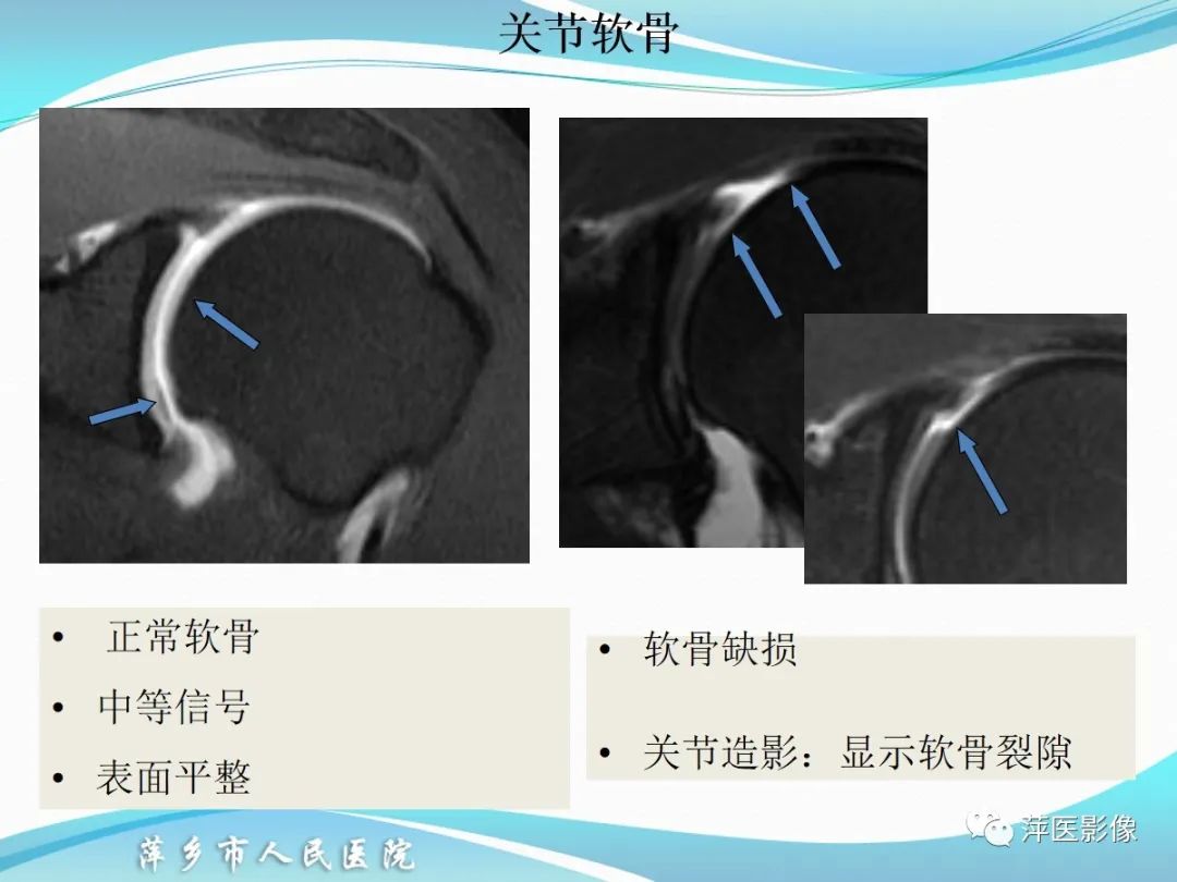 影像PPT - 【PPT】肩关节磁共振读片-58