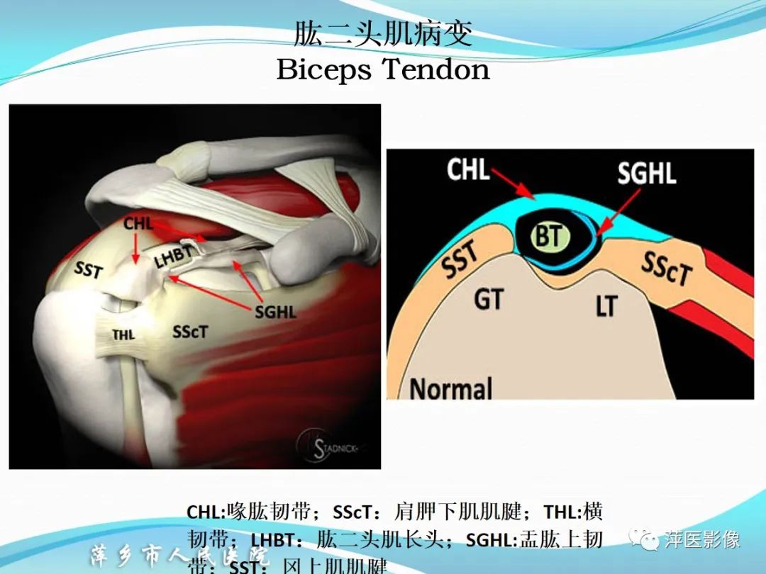 影像PPT - 【PPT】肩关节磁共振读片-60