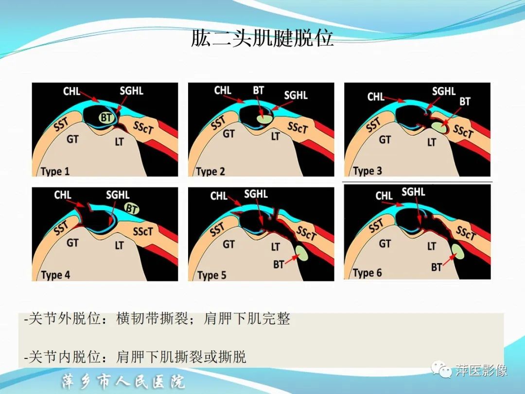影像PPT - 【PPT】肩关节磁共振读片-62