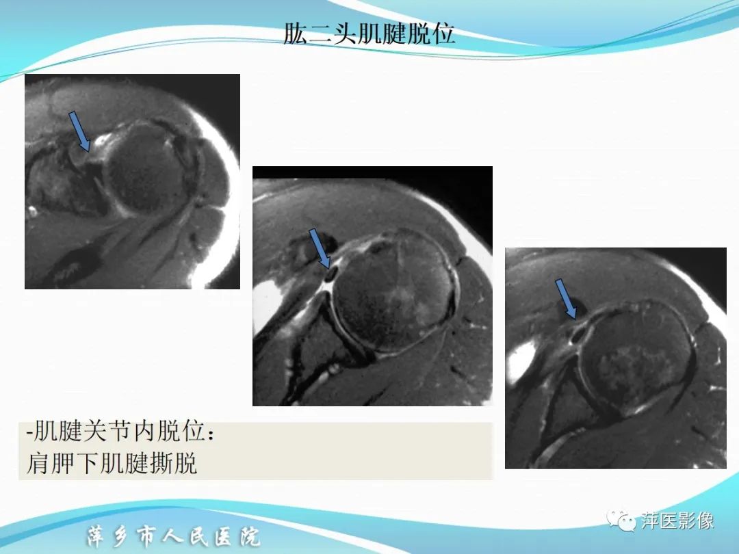 影像PPT - 【PPT】肩关节磁共振读片-63