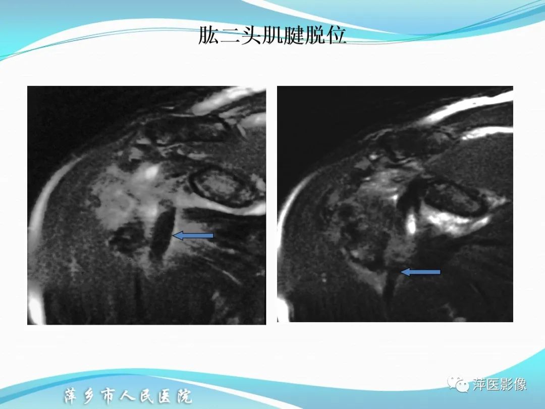 影像PPT - 【PPT】肩关节磁共振读片-64