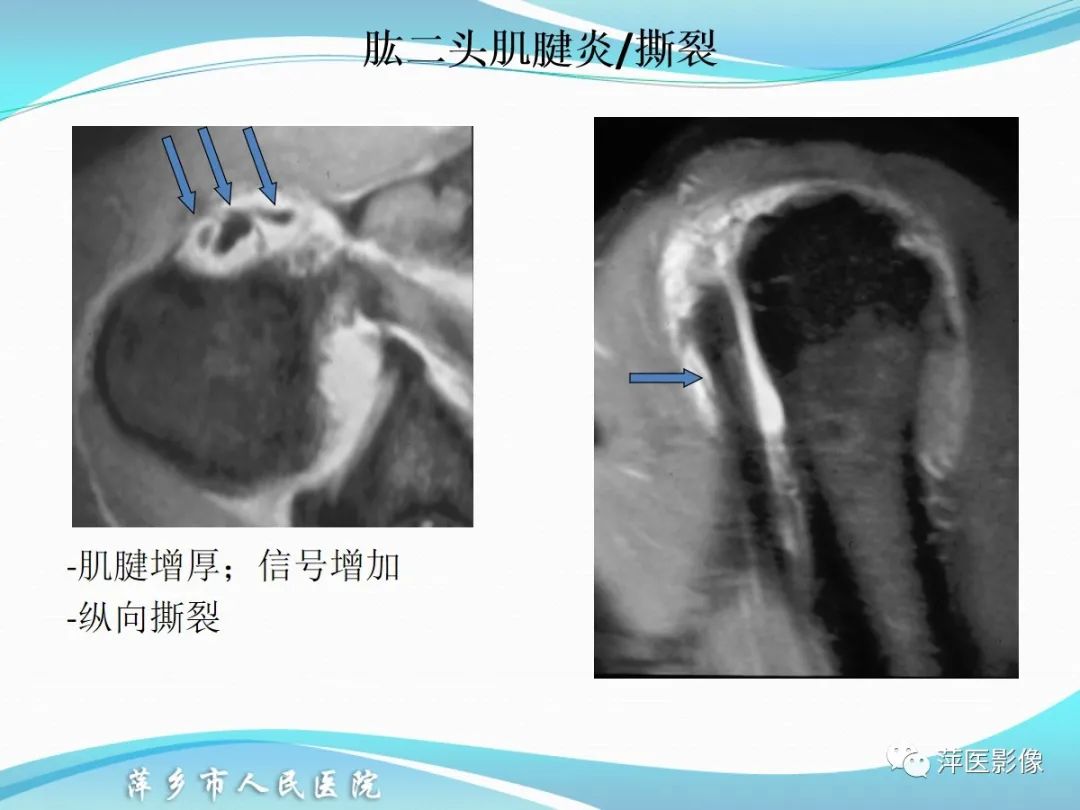影像PPT - 【PPT】肩关节磁共振读片-65