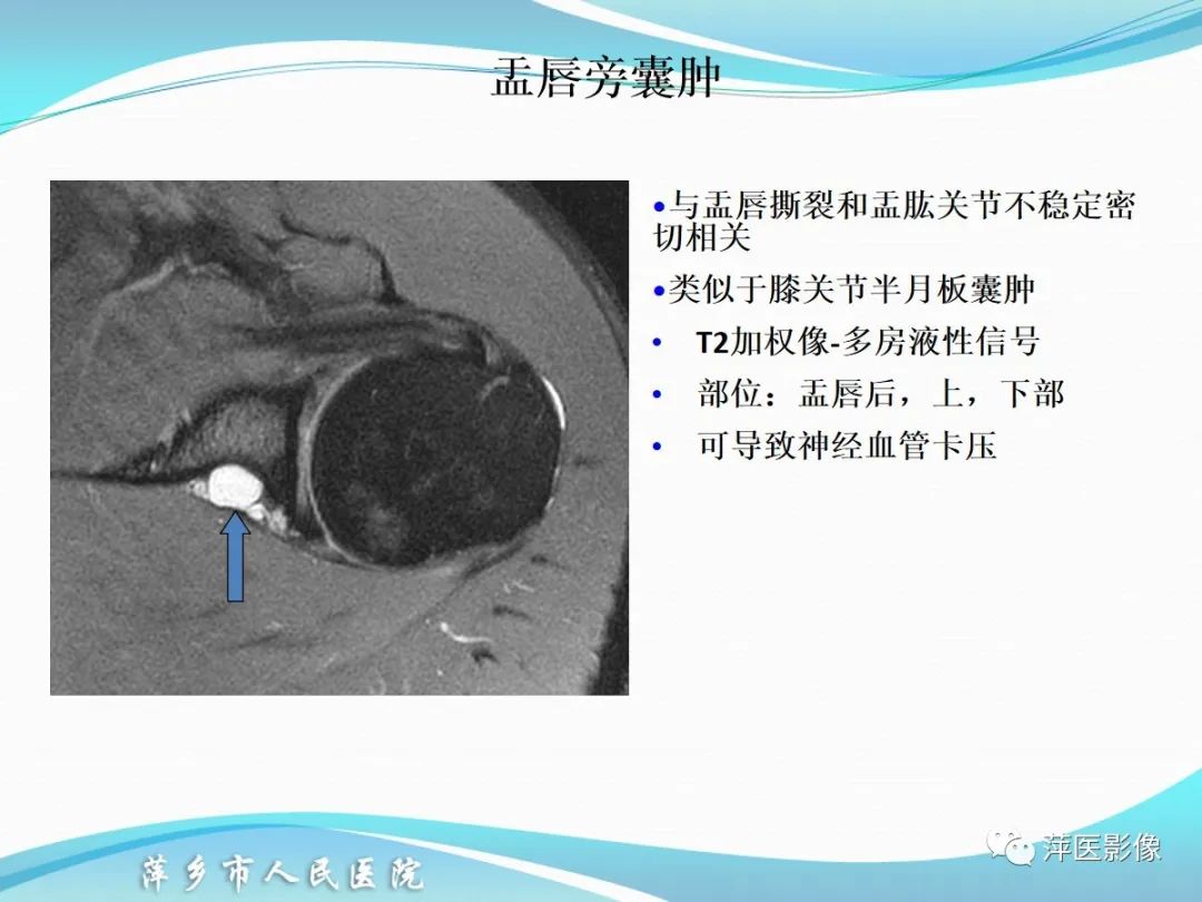 影像PPT - 【PPT】肩关节磁共振读片-66