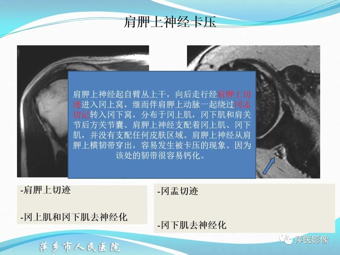 影像PPT - 【PPT】肩关节磁共振读片-67