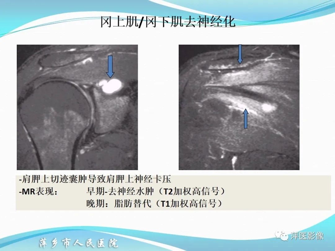 影像PPT - 【PPT】肩关节磁共振读片-68
