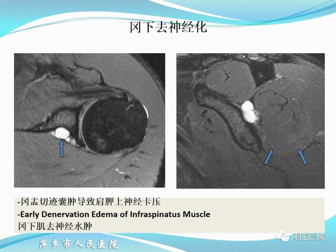 影像PPT - 【PPT】肩关节磁共振读片-69