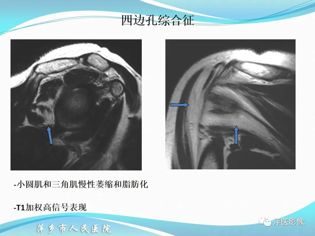 影像PPT - 【PPT】肩关节磁共振读片-71