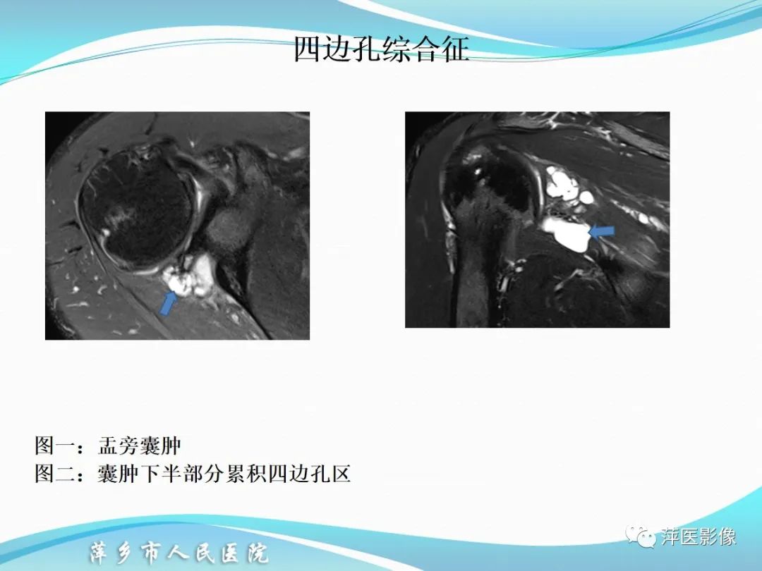 影像PPT - 【PPT】肩关节磁共振读片-72