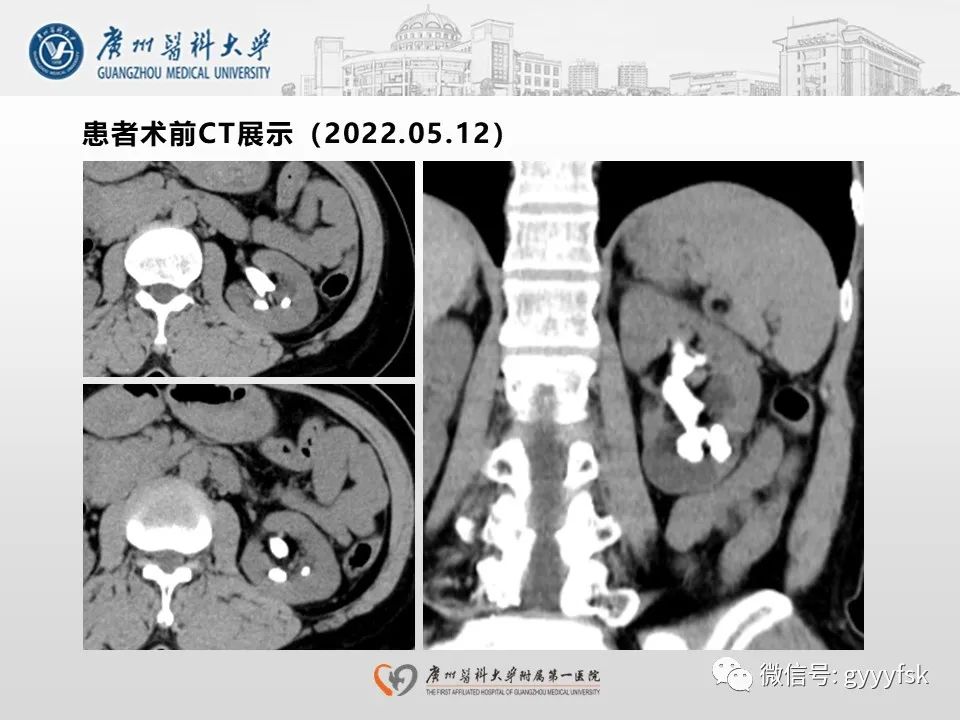 影像PPT - 【PPT】肾假性动脉瘤-3
