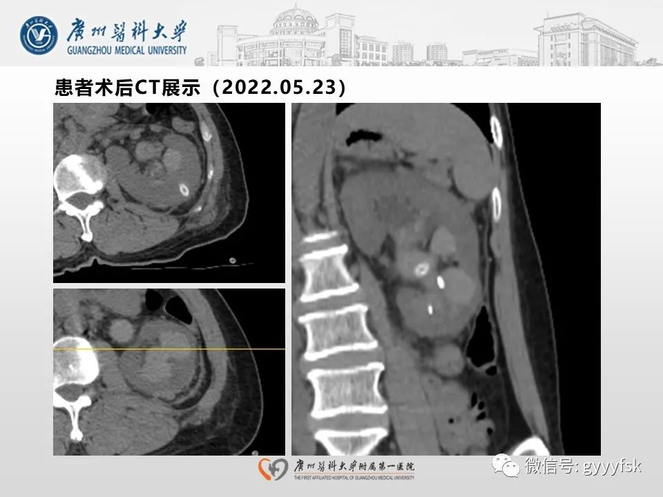 影像PPT - 【PPT】肾假性动脉瘤-5