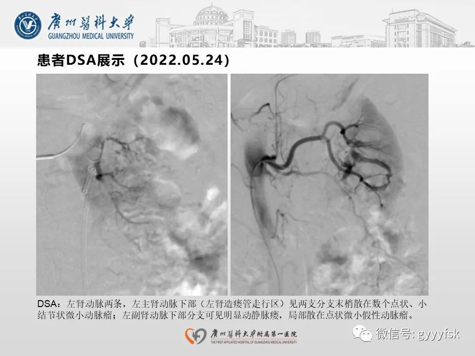 影像PPT - 【PPT】肾假性动脉瘤-7