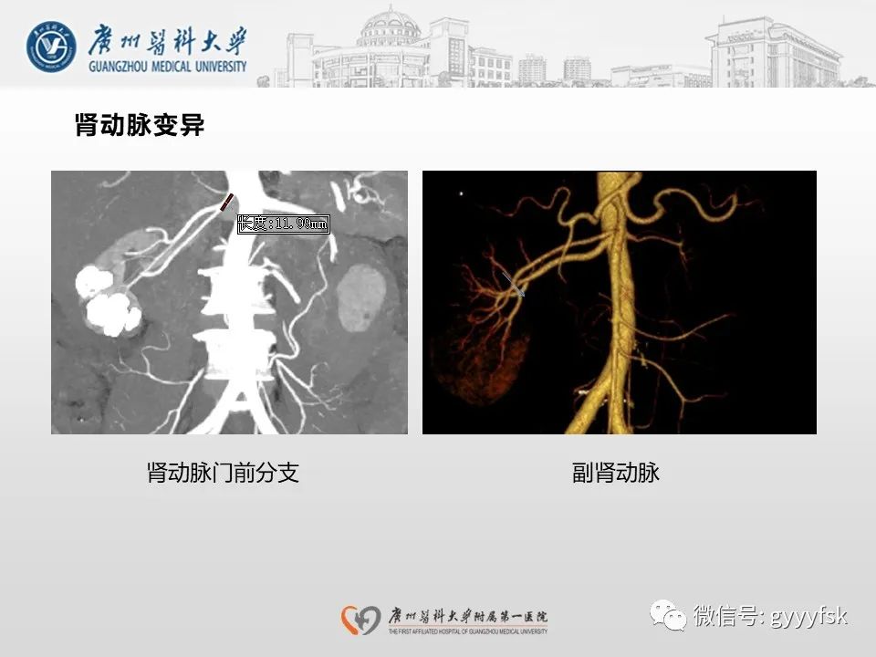 影像PPT - 【PPT】肾假性动脉瘤-16