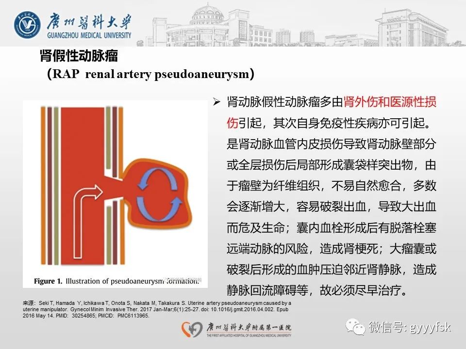 影像PPT - 【PPT】肾假性动脉瘤-20