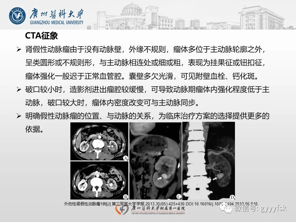影像PPT - 【PPT】肾假性动脉瘤-24