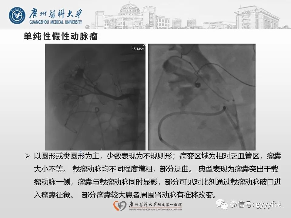 影像PPT - 【PPT】肾假性动脉瘤-25