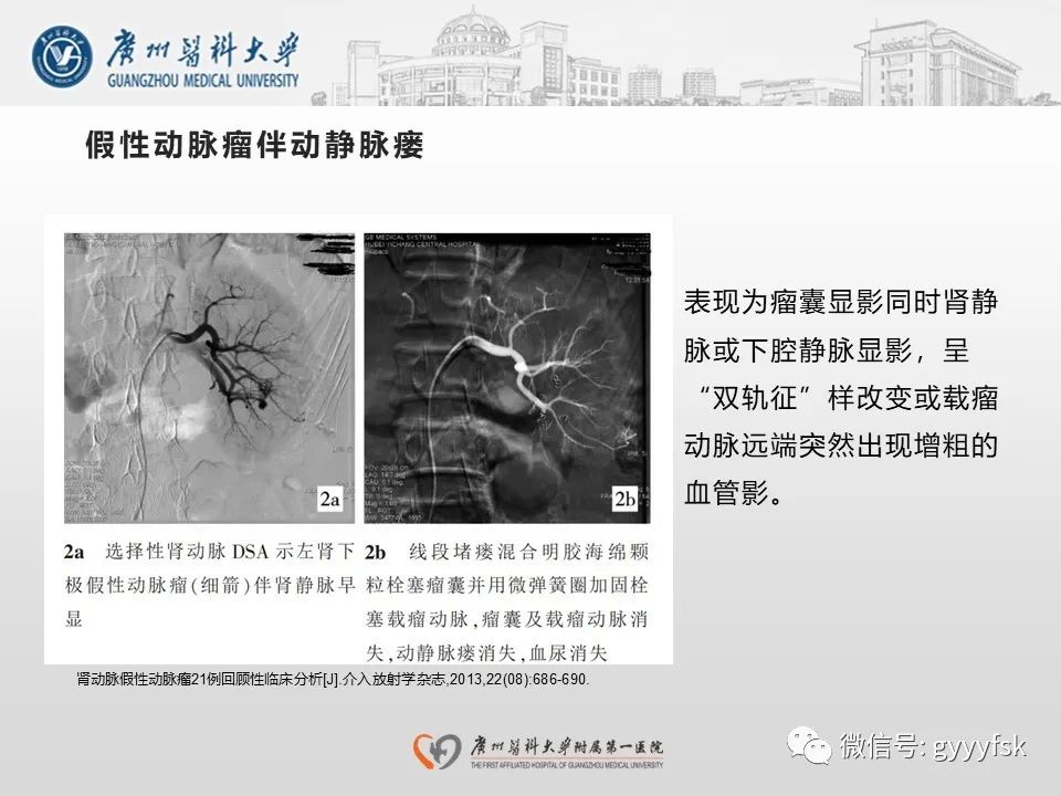 影像PPT - 【PPT】肾假性动脉瘤-26