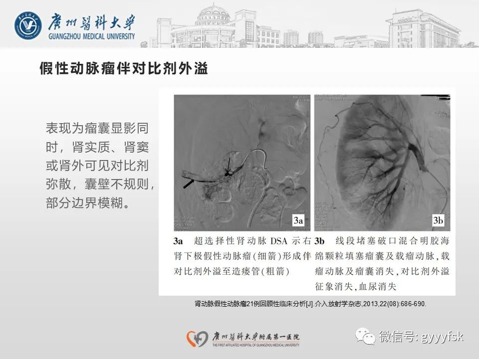 影像PPT - 【PPT】肾假性动脉瘤-27