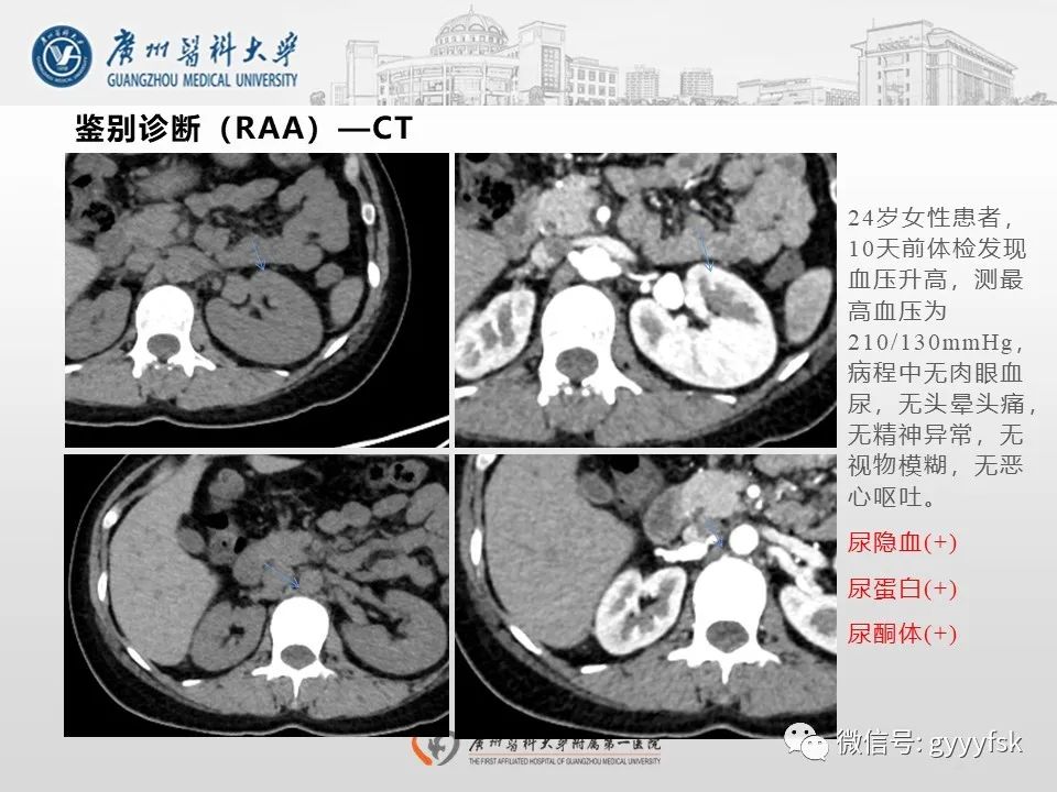 影像PPT - 【PPT】肾假性动脉瘤-30