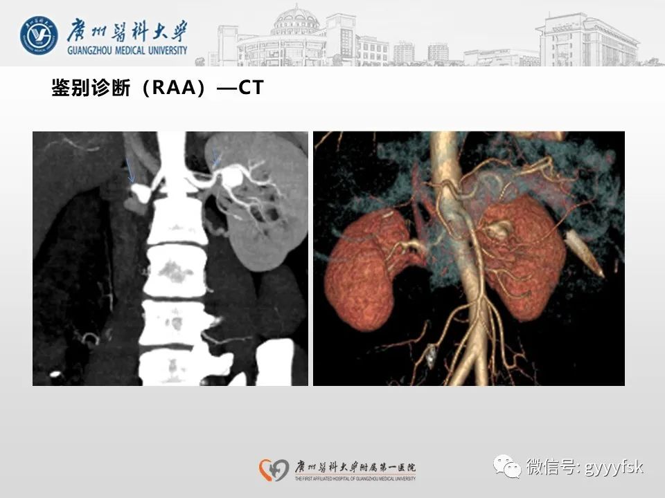 影像PPT - 【PPT】肾假性动脉瘤-31