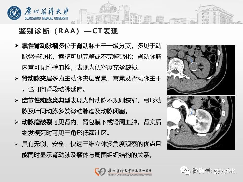 影像PPT - 【PPT】肾假性动脉瘤-33