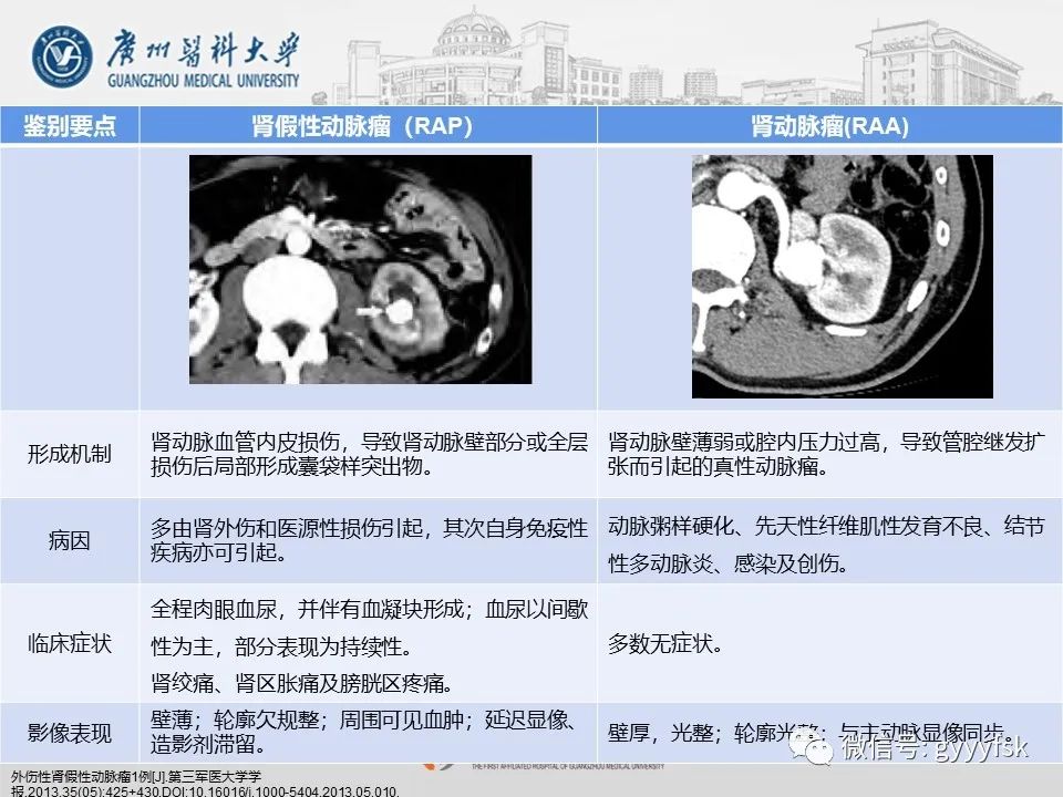 影像PPT - 【PPT】肾假性动脉瘤-34