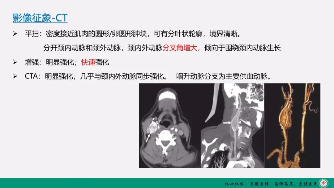 影像PPT - 【PPT】颈动脉体瘤（CBT）影像表现及临床分型-5