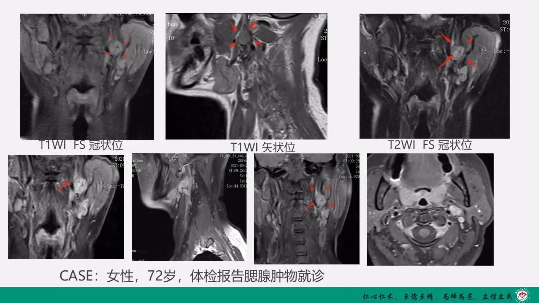 影像PPT - 【PPT】颈动脉体瘤（CBT）影像表现及临床分型-8