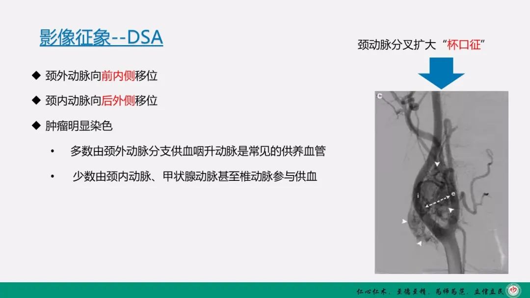 影像PPT - 【PPT】颈动脉体瘤（CBT）影像表现及临床分型-9