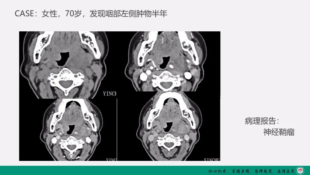 影像PPT - 【PPT】颈动脉体瘤（CBT）影像表现及临床分型-11