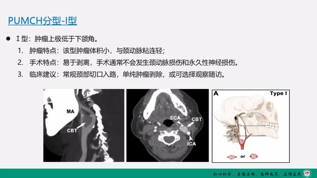 影像PPT - 【PPT】颈动脉体瘤（CBT）影像表现及临床分型-14