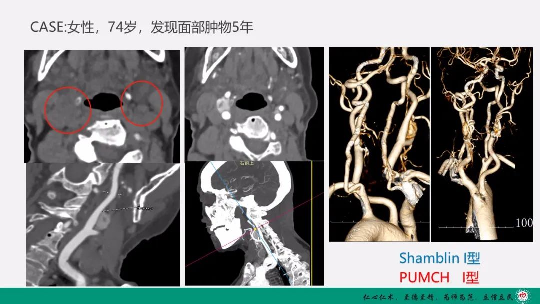 影像PPT - 【PPT】颈动脉体瘤（CBT）影像表现及临床分型-15