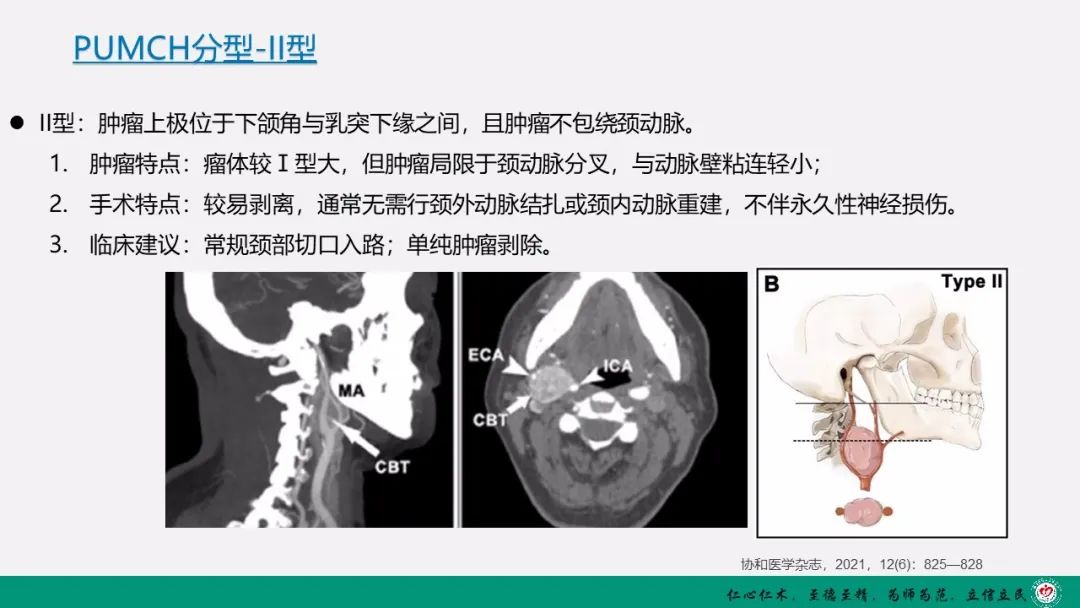 影像PPT - 【PPT】颈动脉体瘤（CBT）影像表现及临床分型-17