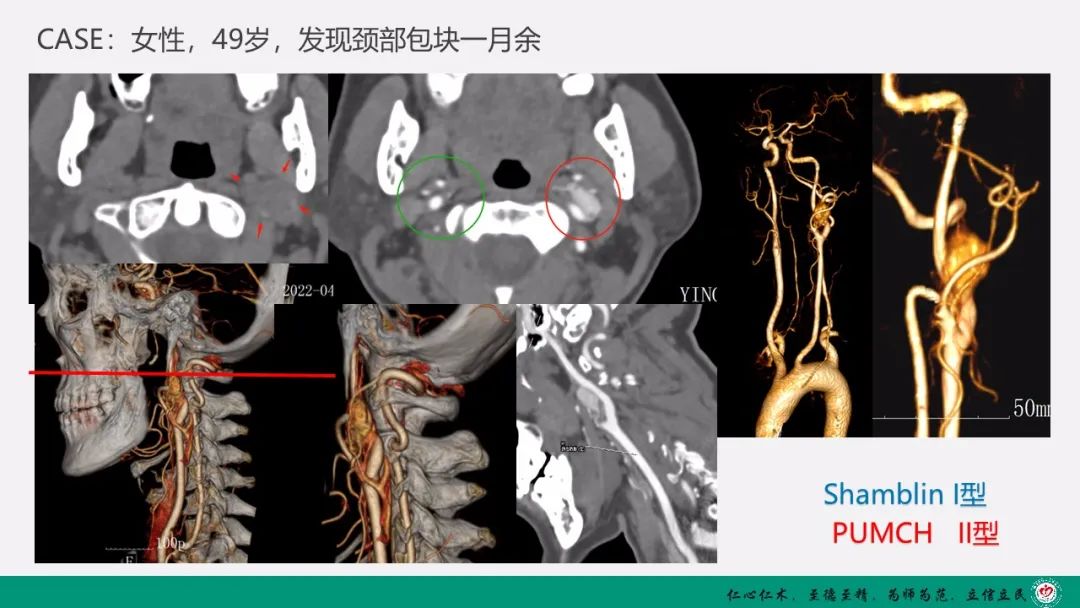 影像PPT - 【PPT】颈动脉体瘤（CBT）影像表现及临床分型-18