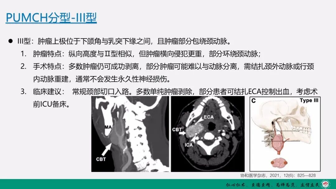 影像PPT - 【PPT】颈动脉体瘤（CBT）影像表现及临床分型-19